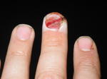 Six days after slamming finger in car door and getting it stitched up.
