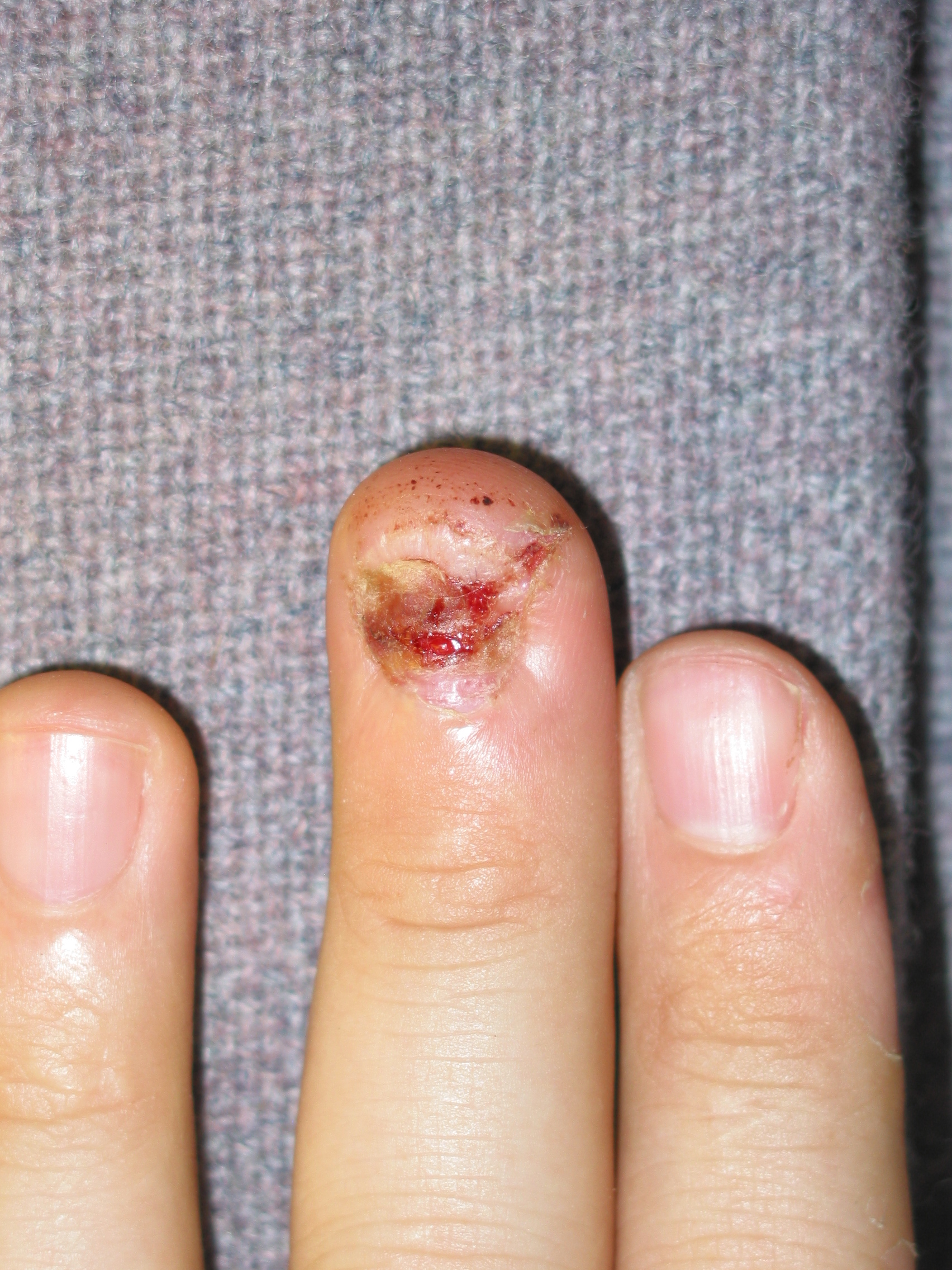 Eleven days after.  Stitches have been removed.