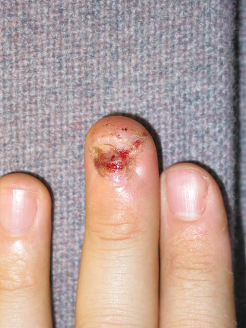 Eleven days after.  Stitches have been removed.