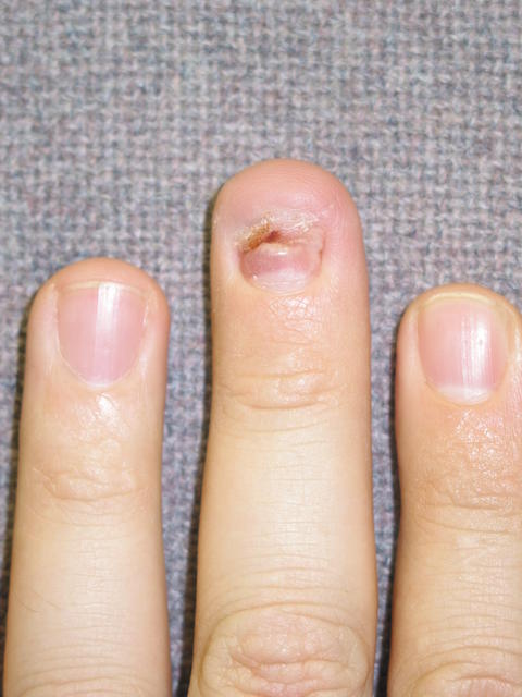 T + 34 days. Most of the laceration has healed up nicely, but there was one spot that didn't. Yesterday the doctor debrided that